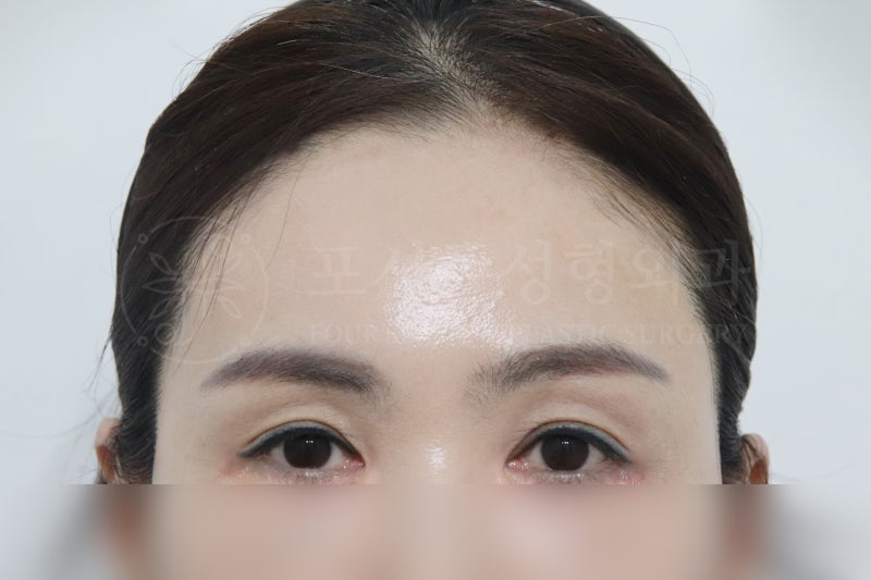 การยกหน้าผากปูซาน หากการทำตาสองชั้นอย่างเดียวไม่เพียงพอ