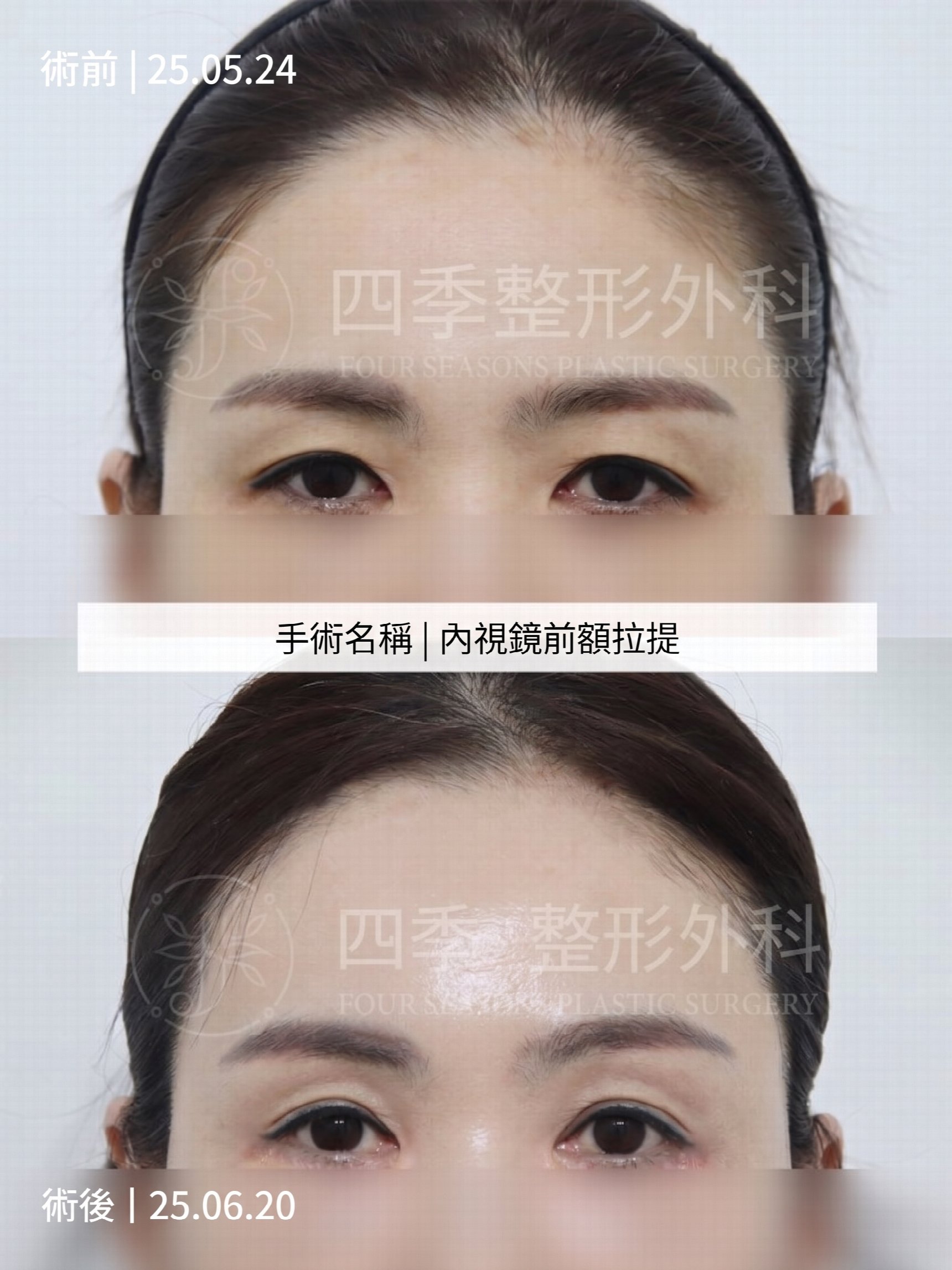釜山額頭拉提：如果只做雙眼皮手術還不夠