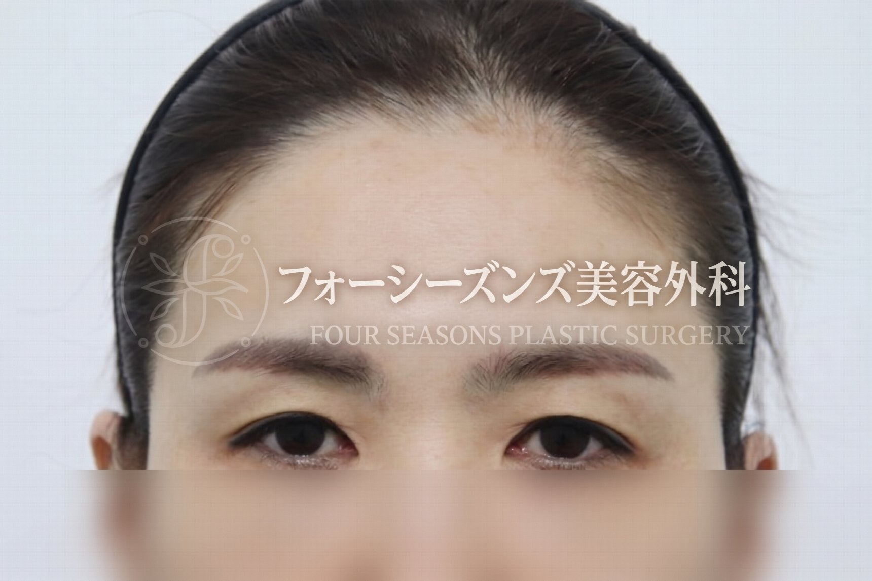 釜山額リフト、二重まぶた手術だけでは不十分な場合