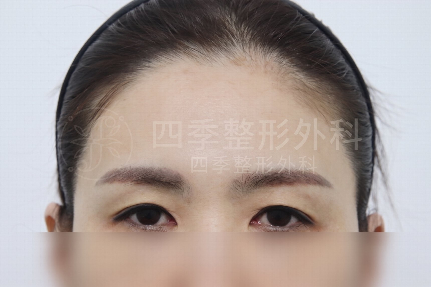 釜山額頭拉提：如果只做雙眼皮手術還不夠