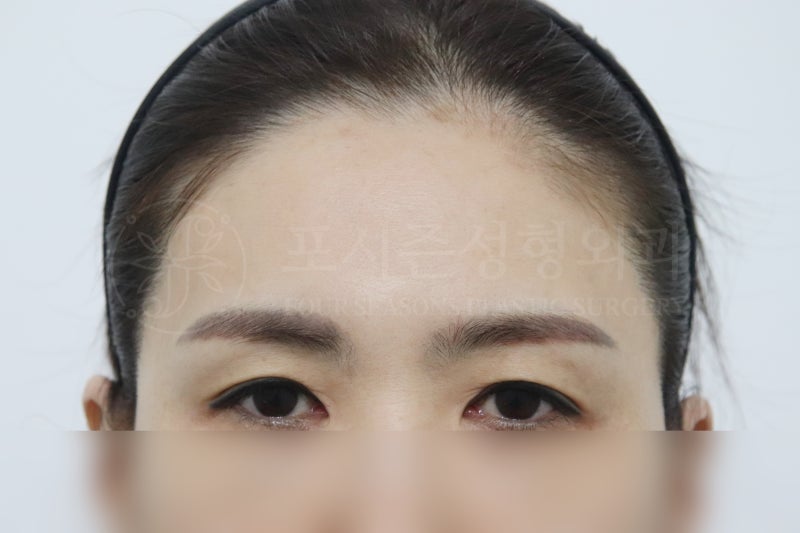 การยกหน้าผากปูซาน หากการทำตาสองชั้นอย่างเดียวไม่เพียงพอ