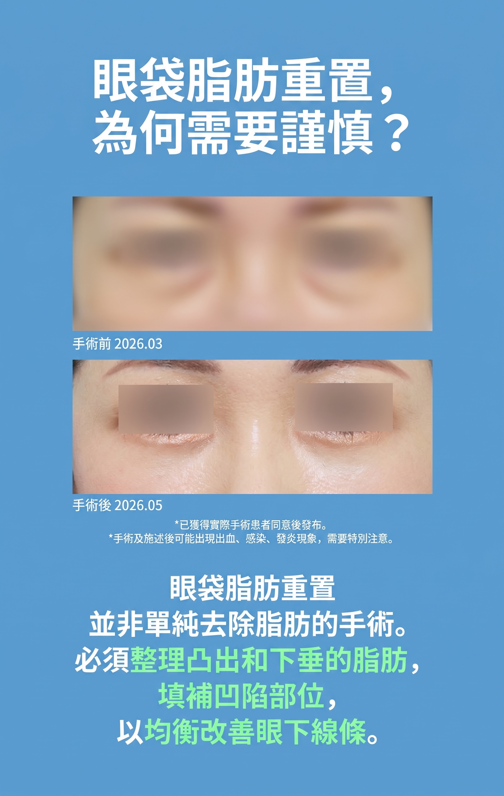 眼底脂肪重新排列，一次改善黑眼圈和眼底浮腫