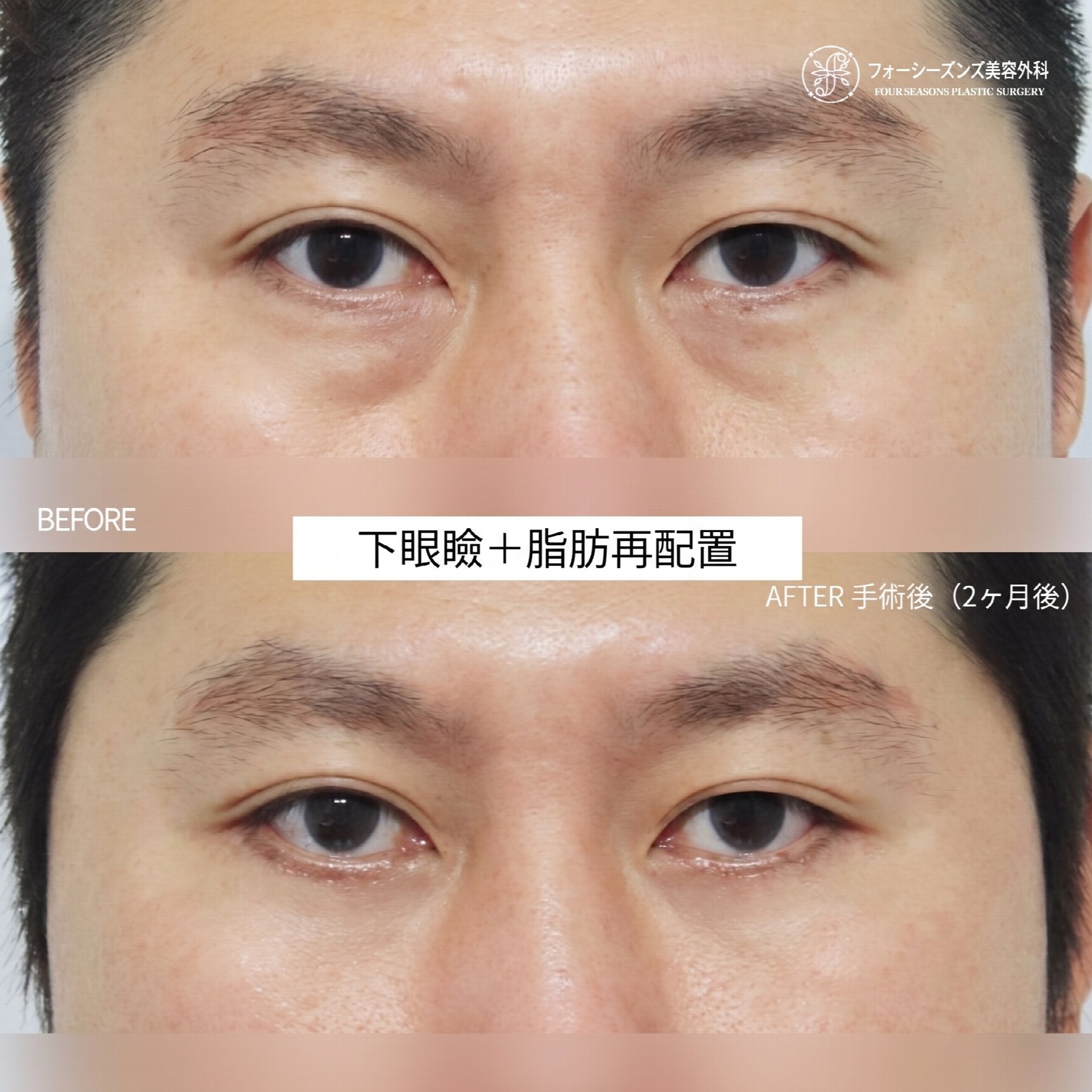西面下眼瞼手術 費用が異なる理由とは?