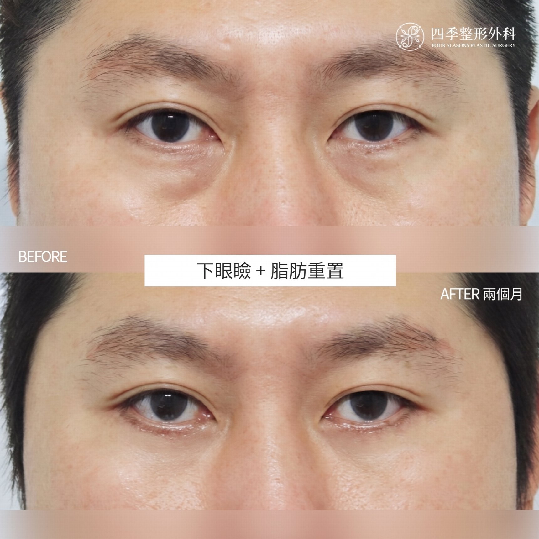 西面下眼瞼手術 費用差異的原因何在？
