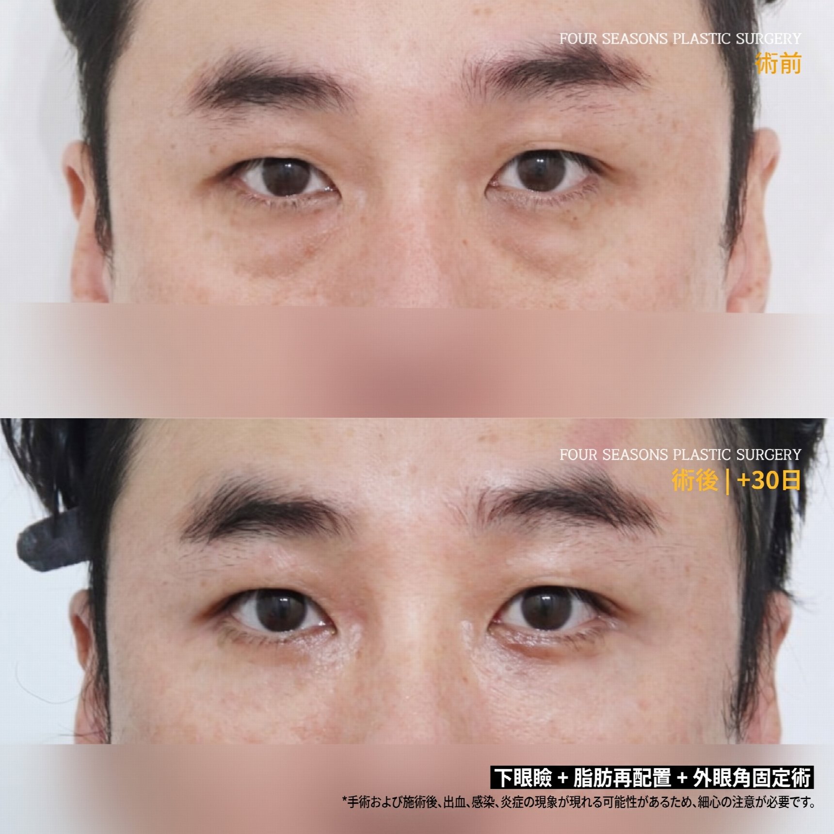 西面下眼瞼手術 費用が異なる理由とは?