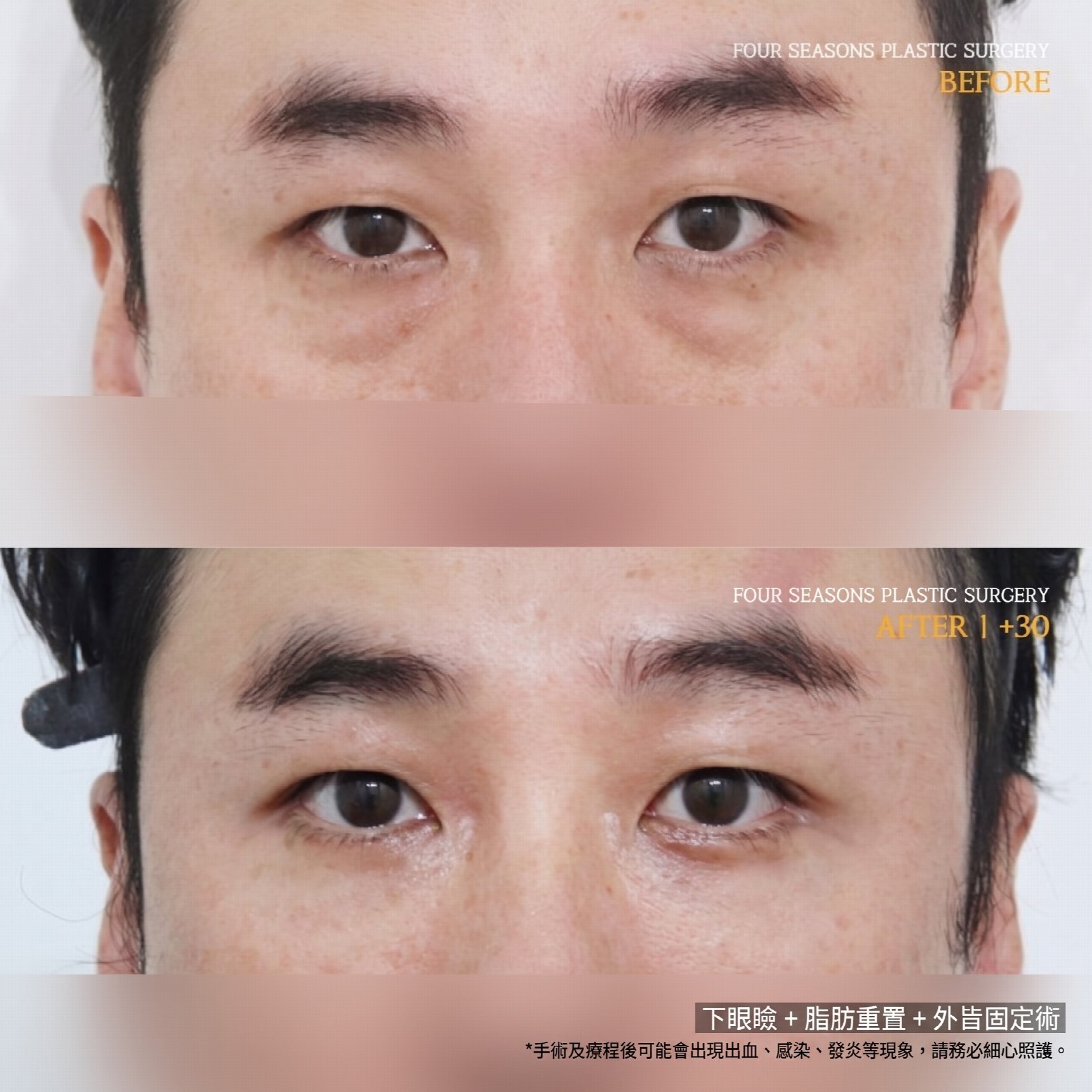西面下眼瞼手術 費用差異的原因何在？