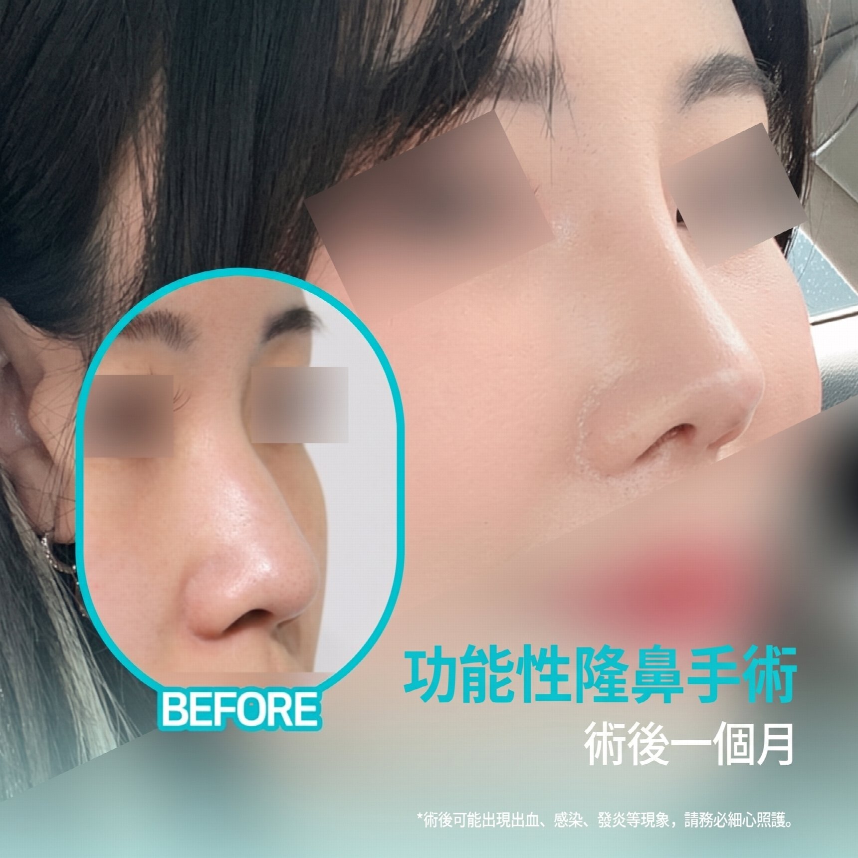 釜山功能性鼻整形:同時改善結構性鼻炎與外觀問題