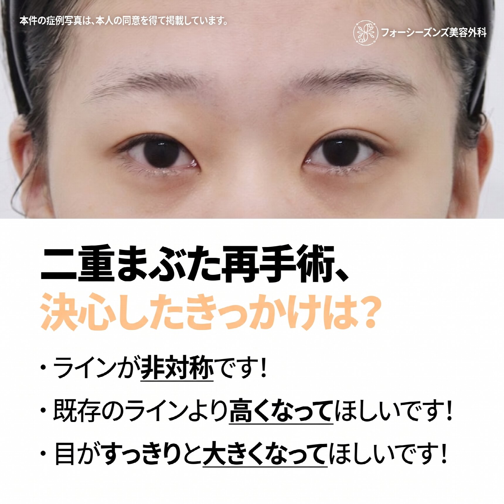 西面（ソミョン）二重再手術 自分に似合う目元を再設計するプロセスとは