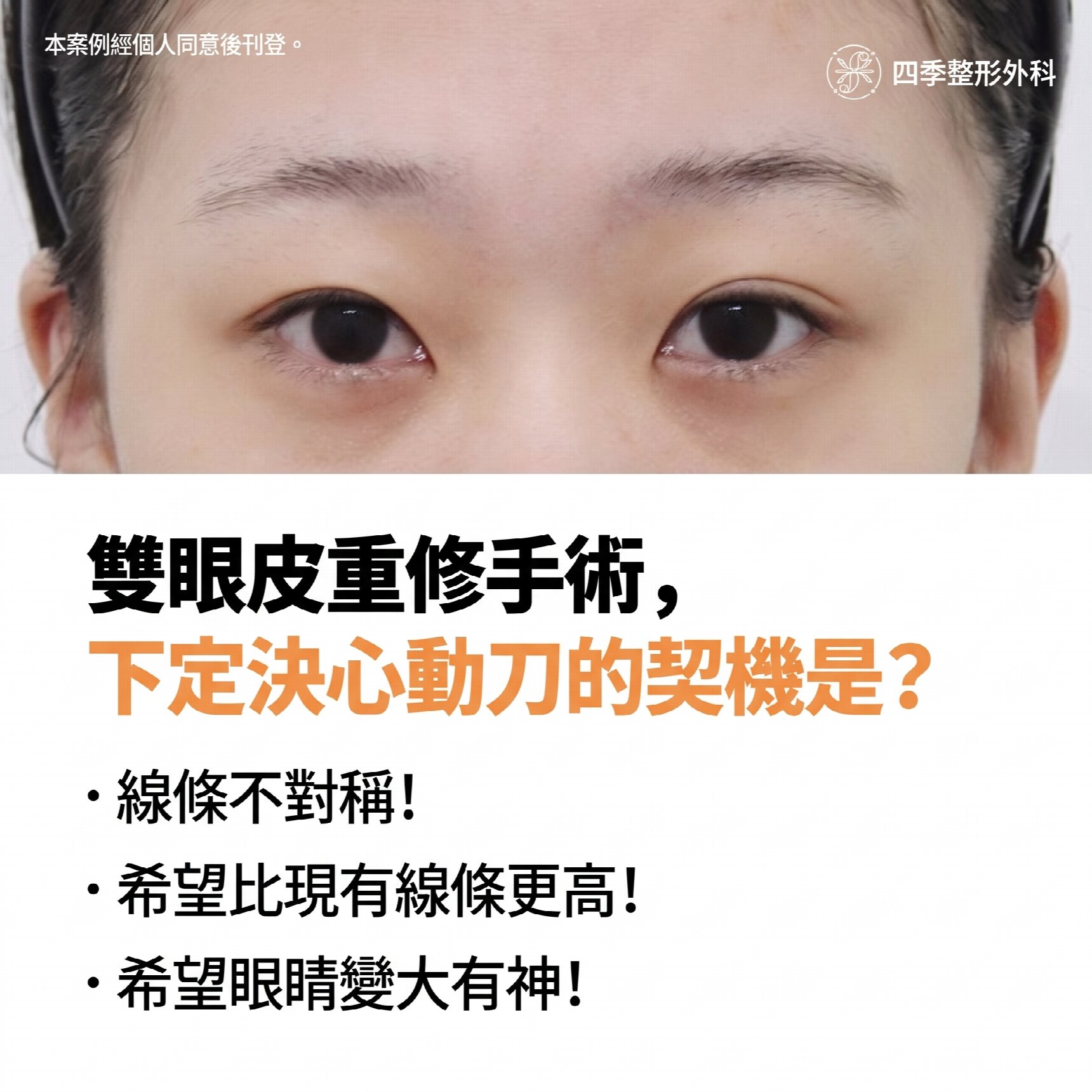 西面雙眼皮修復手術：重新為我量身打造專屬眼型的全過程