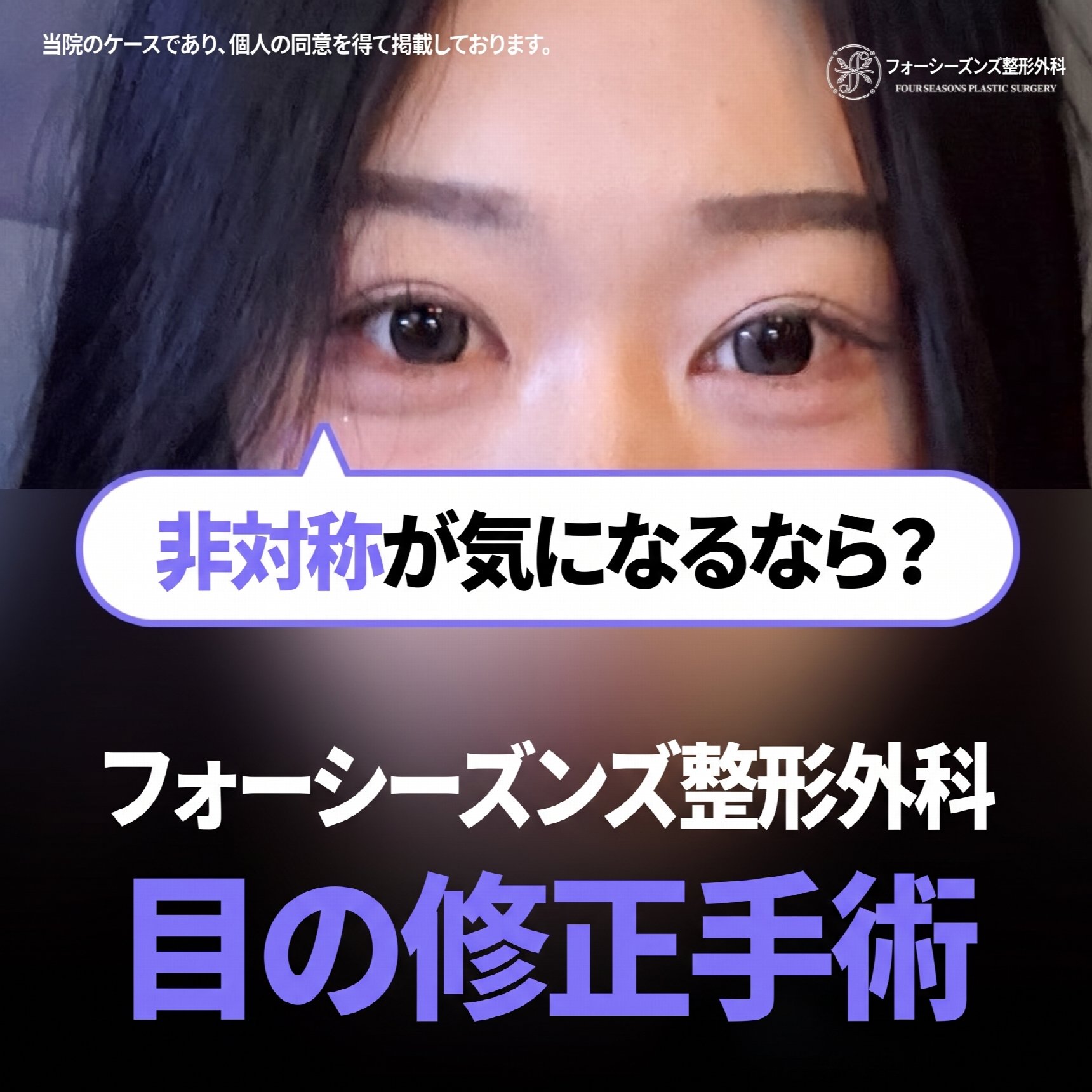 西面（ソミョン）二重再手術 自分に似合う目元を再設計するプロセスとは