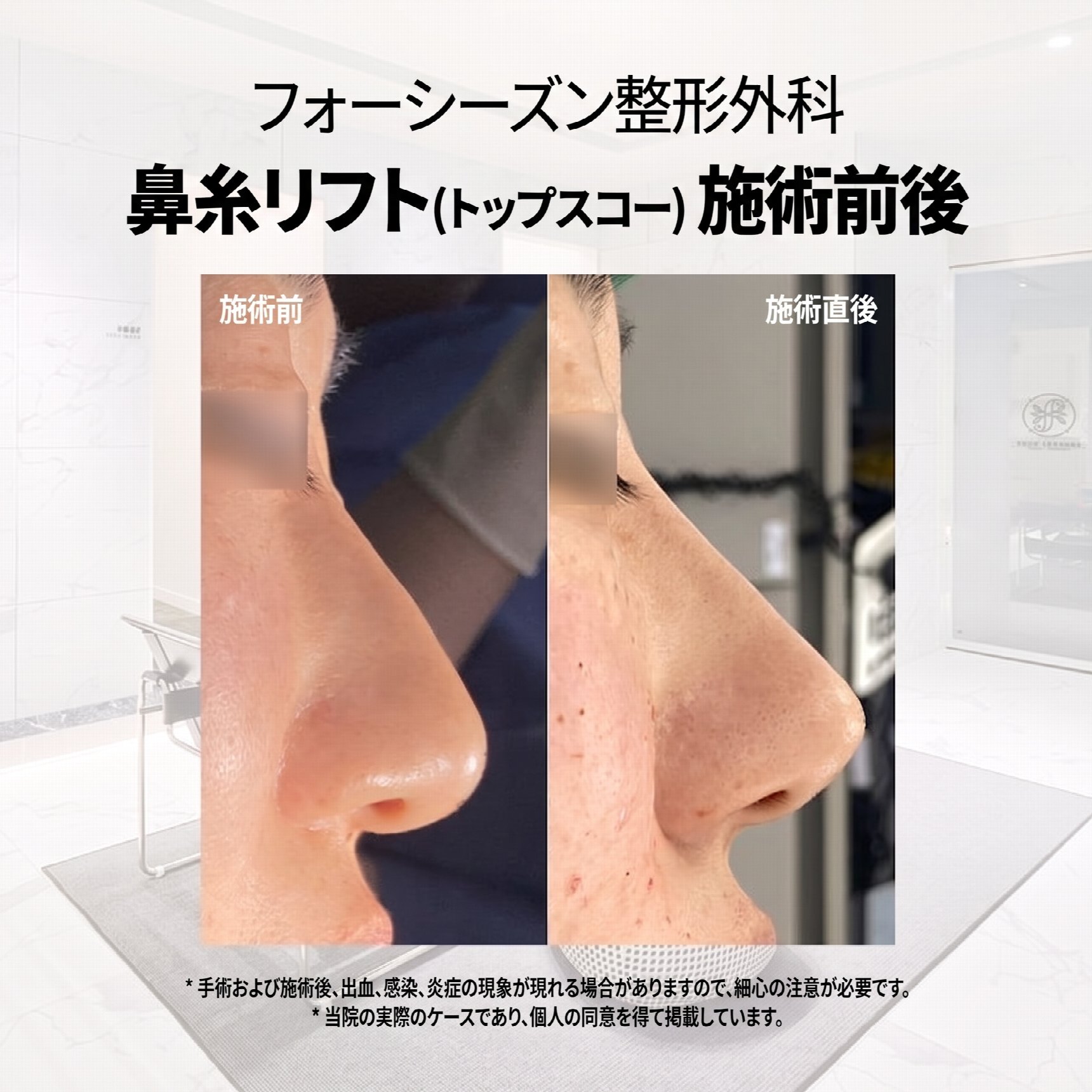 釜山鼻スレッドリフト：切開なしで鼻筋や小鼻を改善できる？