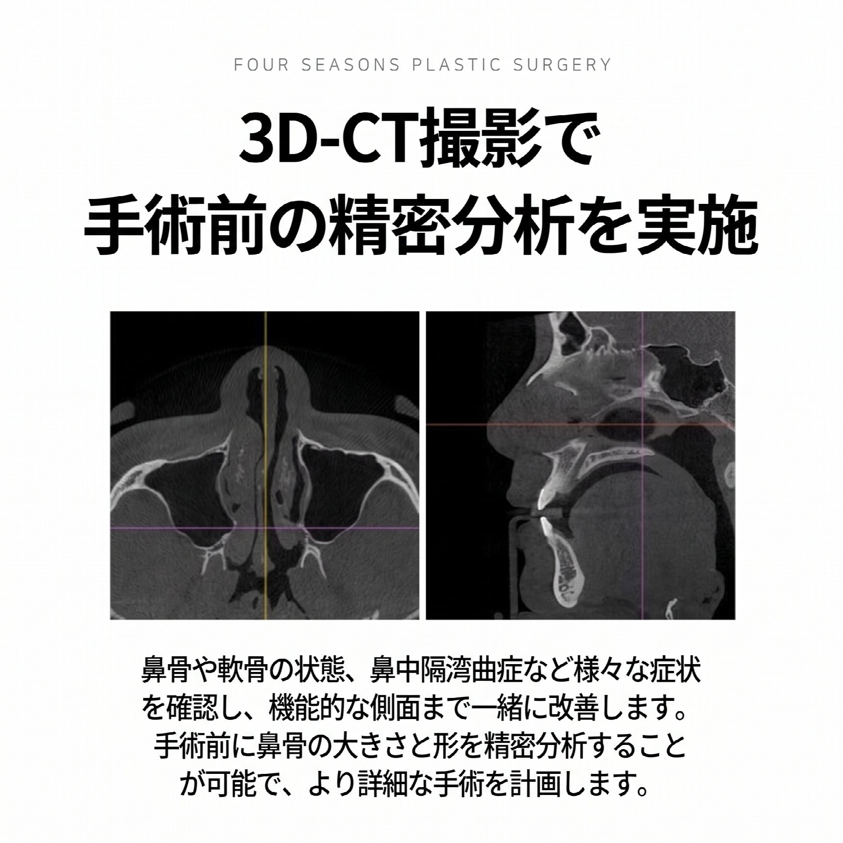 釜山のメンズ鼻整形、鼻筋の高さよりも重要なのは「顔との調和」