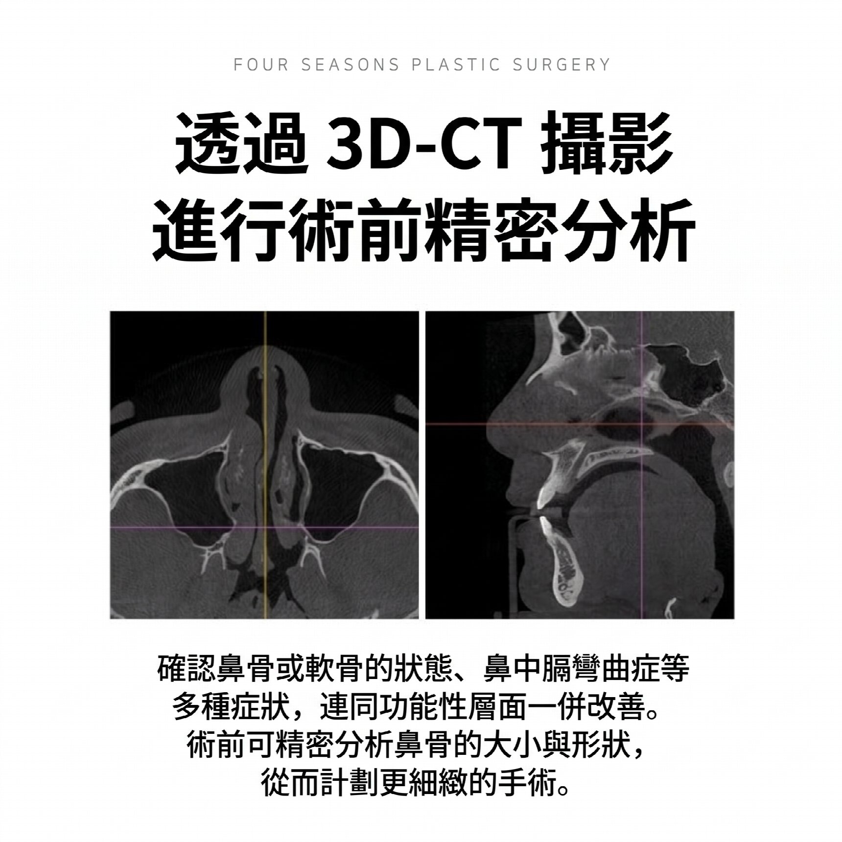 釜山男性隆鼻 比起鼻樑高度更重要的是與臉型的協調感