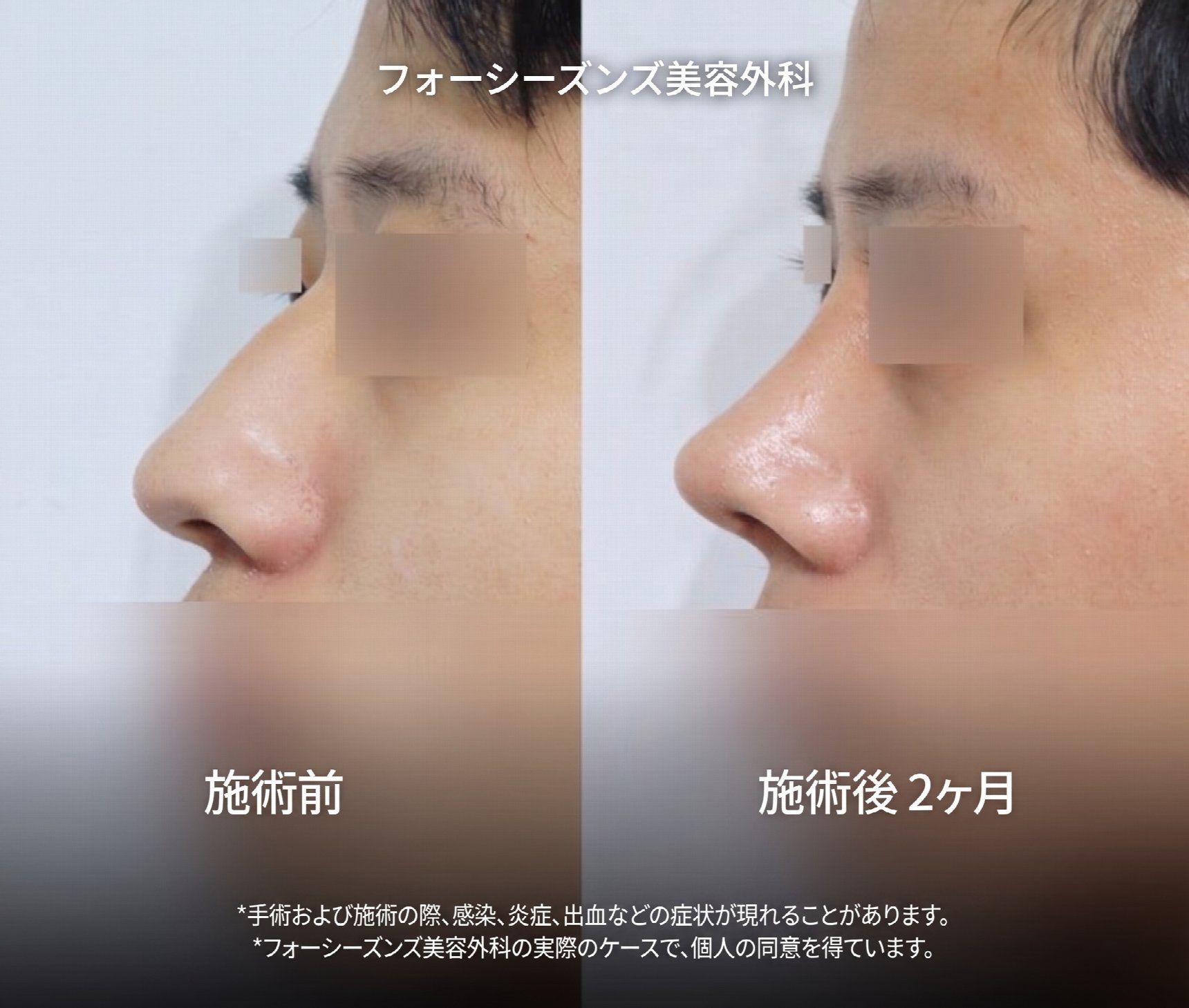 釜山のメンズ鼻整形、鼻筋の高さよりも重要なのは「顔との調和」