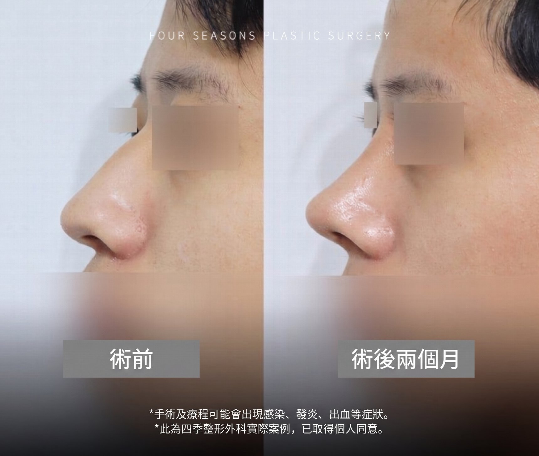 釜山男性隆鼻 比起鼻樑高度更重要的是與臉型的協調感