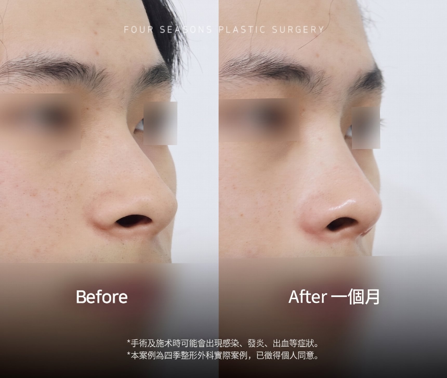 釜山男性隆鼻 比起鼻樑高度更重要的是與臉型的協調感