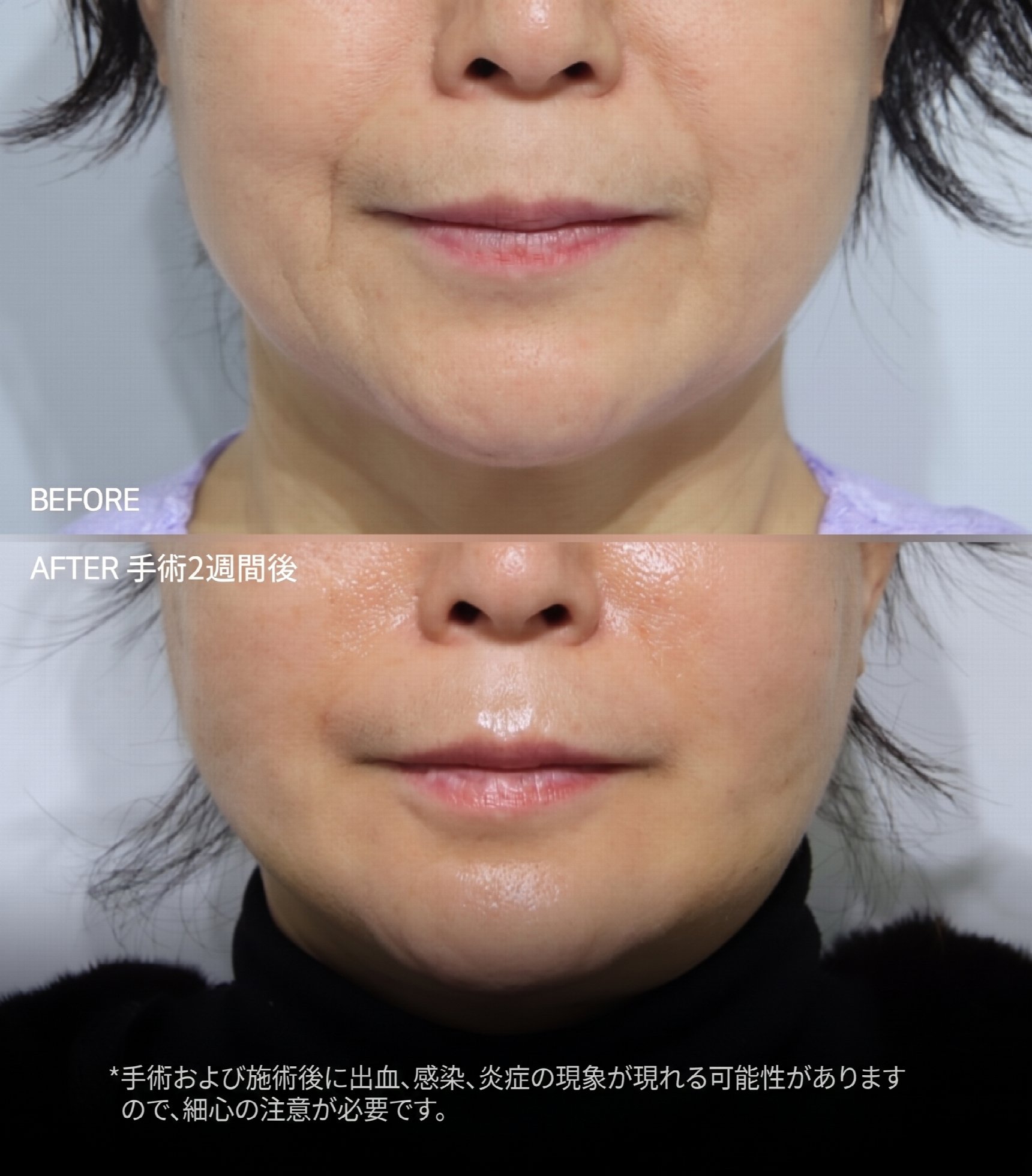 釜山ミニリフト、単に皮膚だけを引き上げてはいけない理由