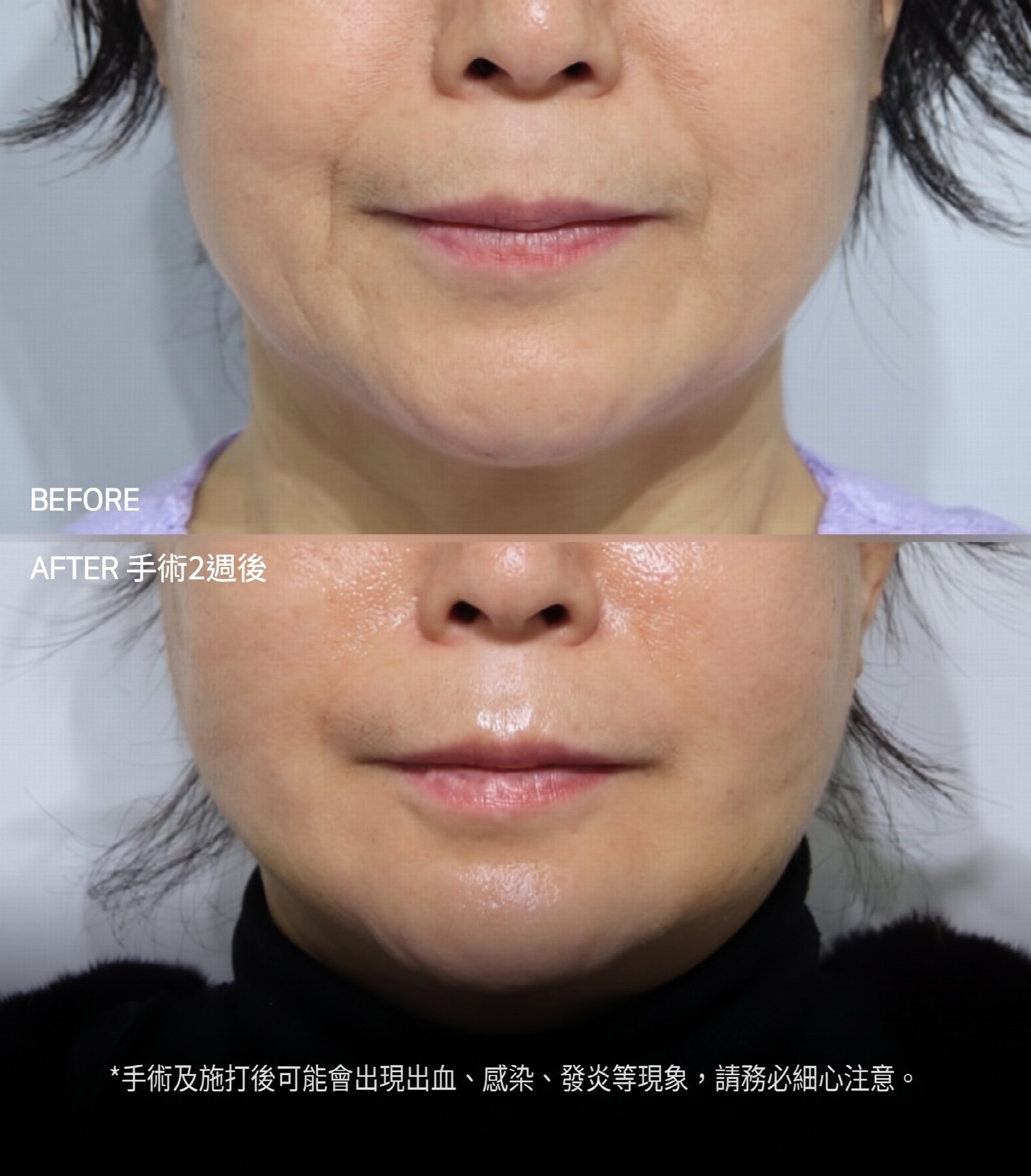 釜山迷你拉皮：為什麼不能只單純拉緊皮膚？