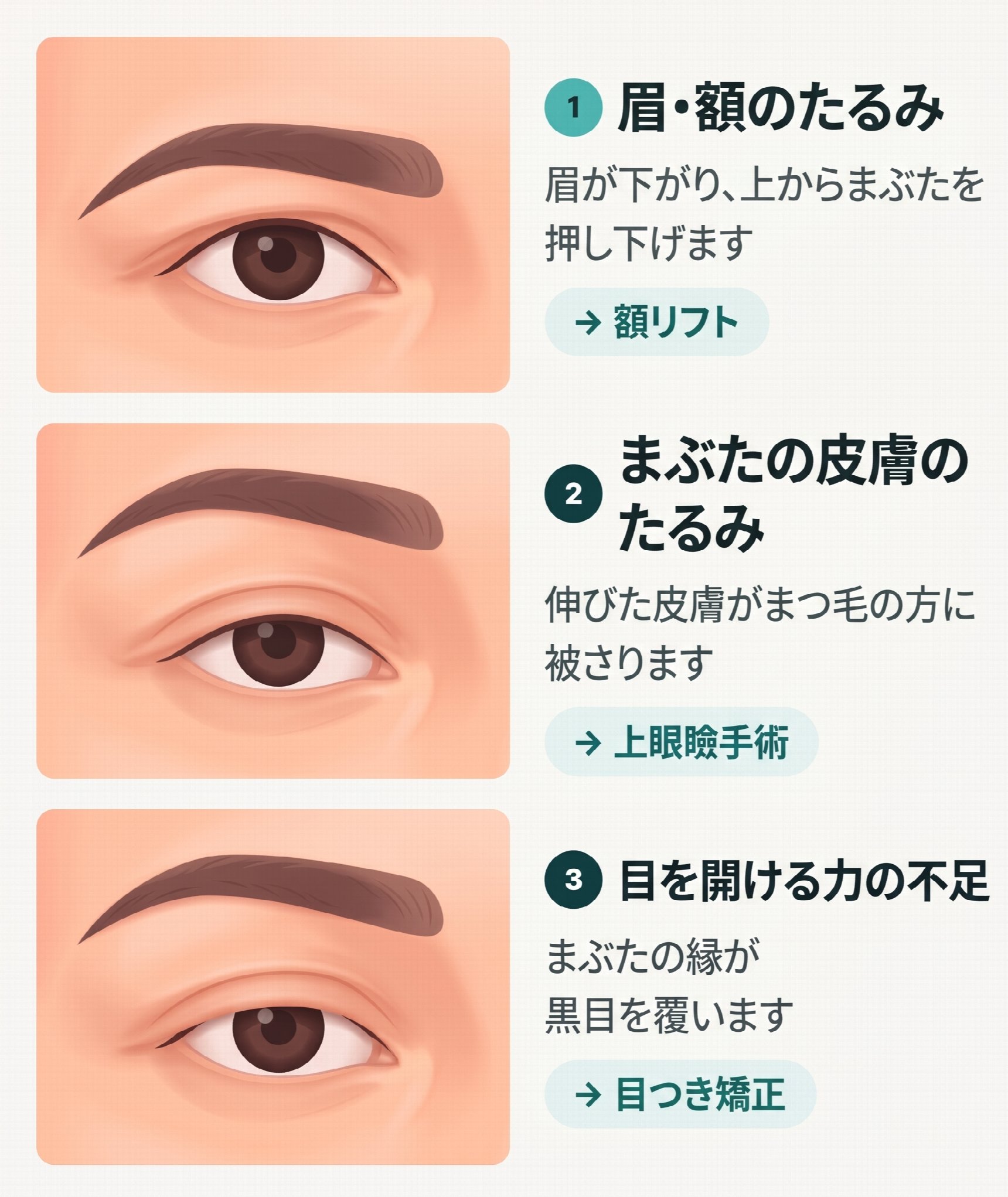 釜山額リフト｜二重手術をしたのに目が重苦しいなら？額の垂れ下がりを確認すべき理由