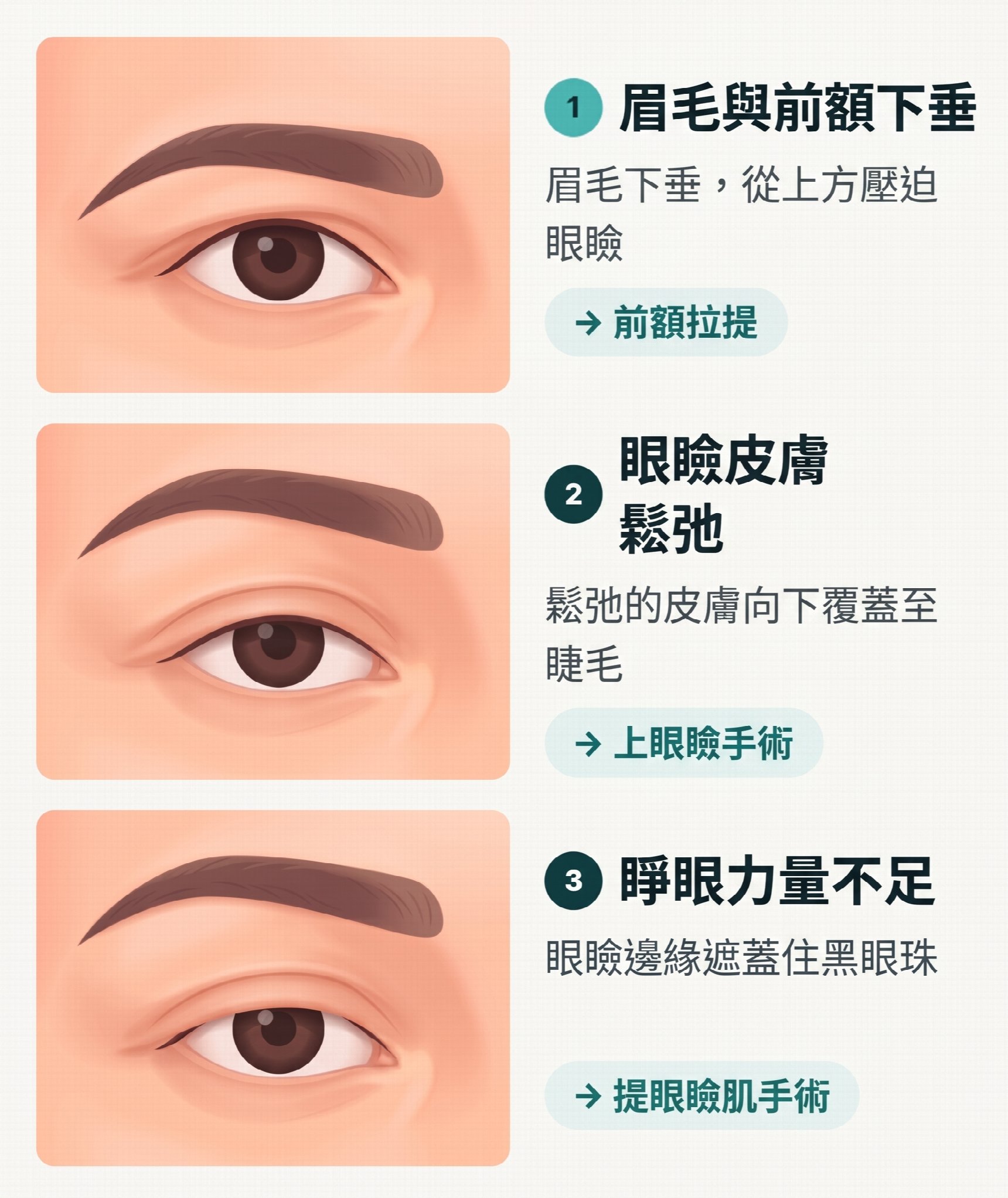 釜山額頭提拉：做了雙眼皮手術，眼睛還是覺得悶？為什麼要確認額頭下垂