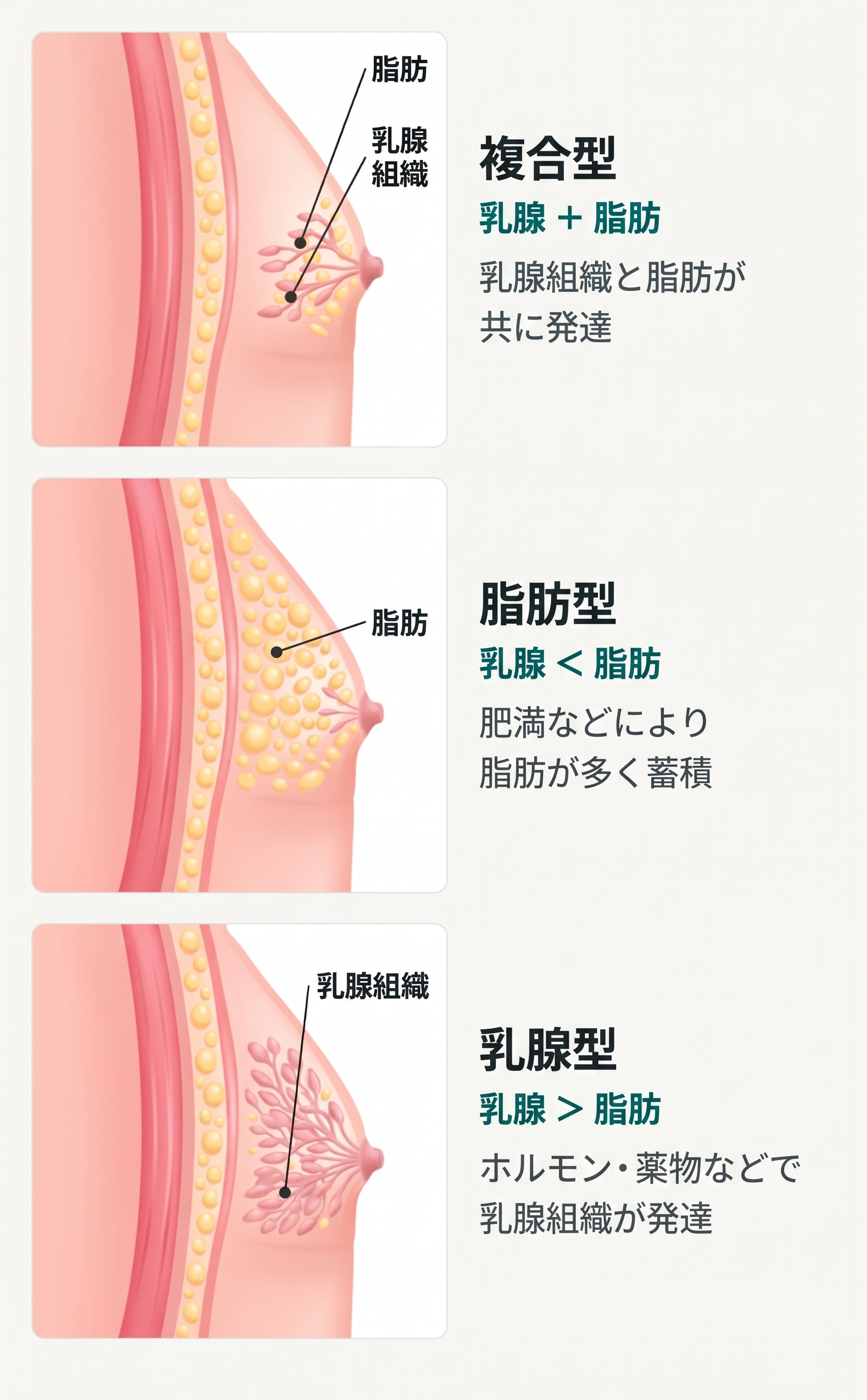 釜山の女性化乳房手術|ダイエットしても胸だけそのままなら?脂肪か乳腺組織かを確認しましょう