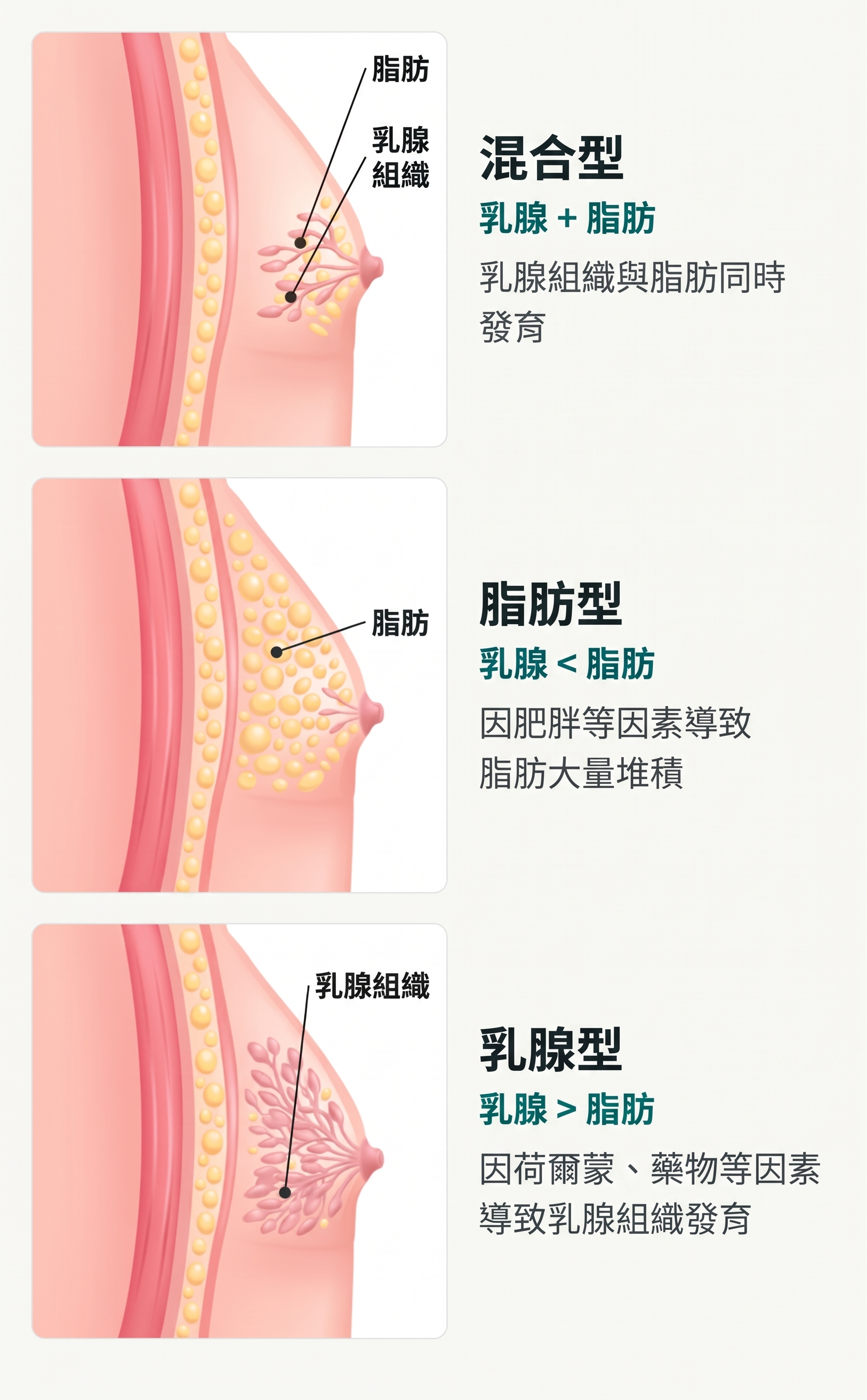 釜山男性女乳症手術｜減肥了胸部還是沒變？先確認是脂肪還是乳腺組織