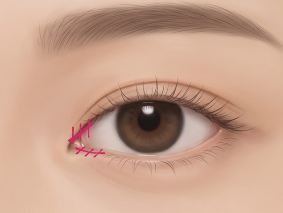 完成開眼頭縫合的眼頭示意圖