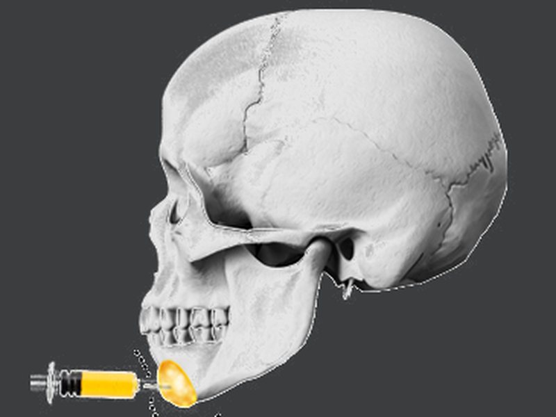 於下巴前端注射填充劑的側面顱骨示意圖