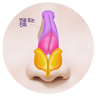 들어간 부위에 연골 또는 진피를 이식해 채운 코의 정면 단면 일러스트