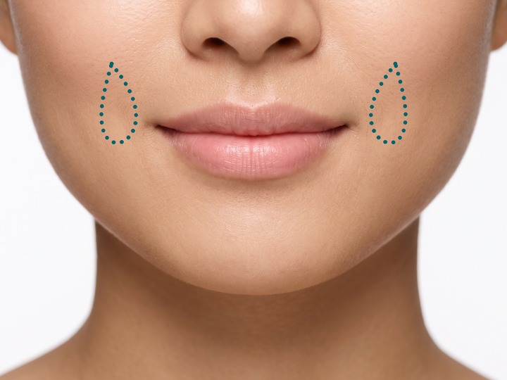 Phần dưới khuôn mặt với vị trí tạo má lúm đồng tiền được đánh dấu bằng nét chấm ở hai bên má