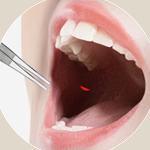 Hình minh họa dùng dụng cụ rạch một đường nhỏ trên niêm mạc má bên trong khoang miệng đang mở