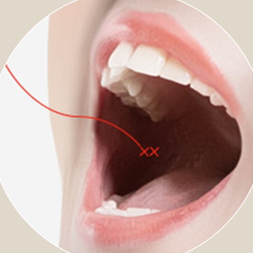 Hình minh họa vị trí rạch bên trong miệng được khâu buộc bằng chỉ để cố định mô dưới da