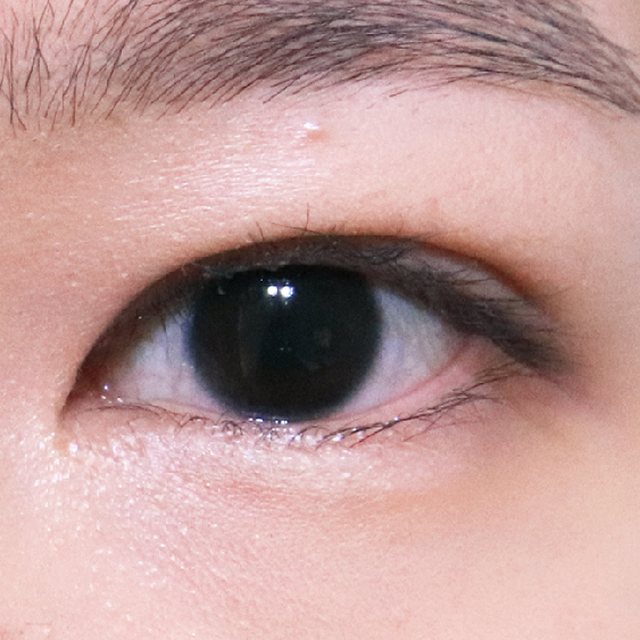 Front view of eyes 3 months after incisional double eyelid surgery