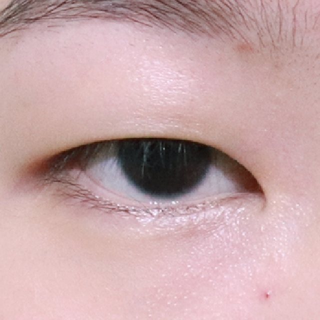 Front view of eyes before incisional double eyelid surgery