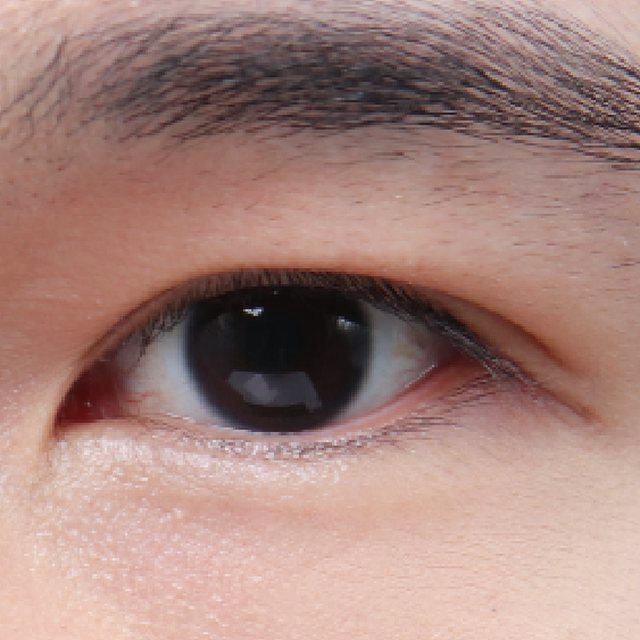 Front view of eyes 3 months after incisional double eyelid surgery