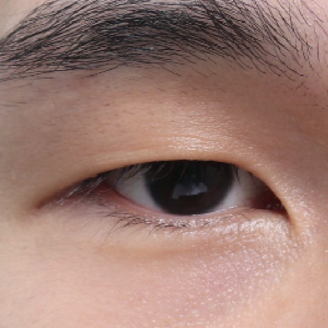 Front view of eyes before incisional double eyelid surgery