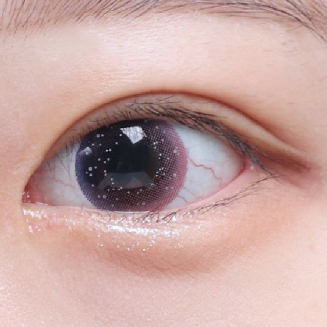 Front view of eyes 3 months after incisional double eyelid surgery