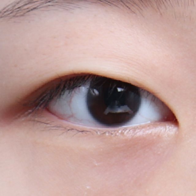 Front view of eyes before incisional double eyelid surgery