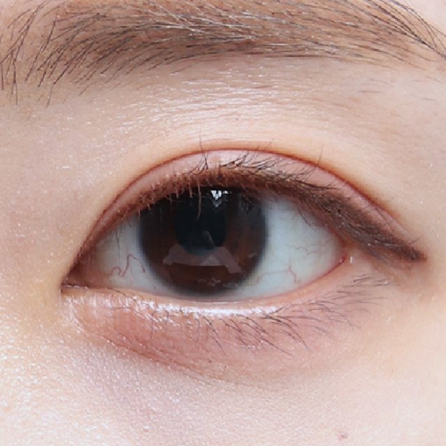 Front view of eyes 3 months after incisional double eyelid surgery