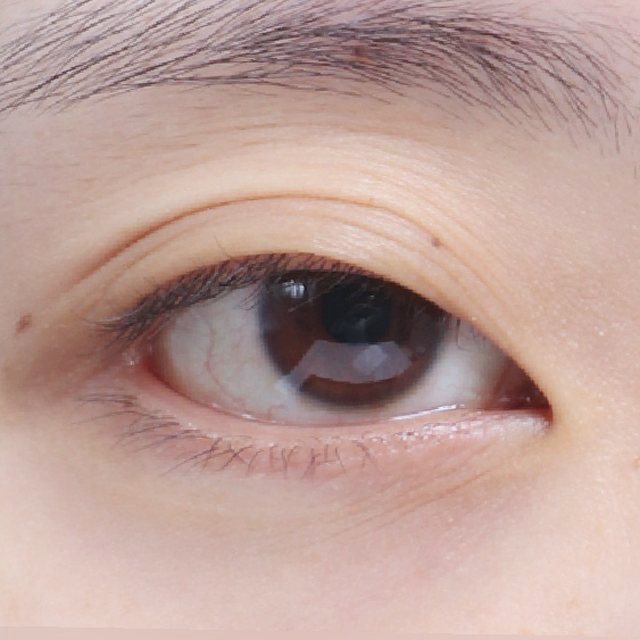 Front view of eyes before incisional double eyelid surgery
