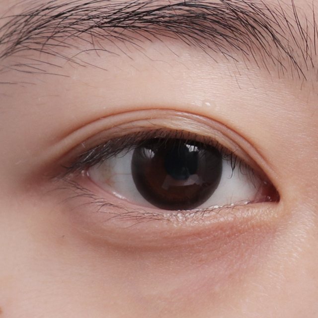 Front view of eyes before natural adhesion double eyelid surgery