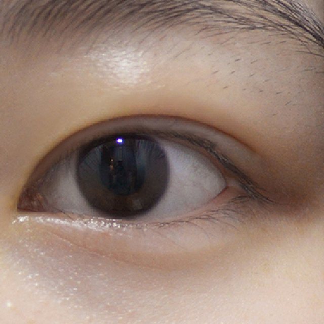 Front view of eyes 3 months after natural adhesion double eyelid surgery
