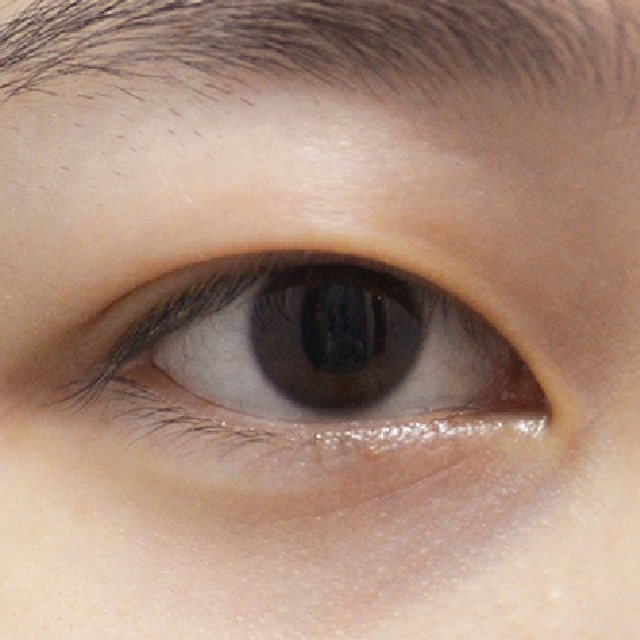 Front view of eyes before natural adhesion double eyelid surgery