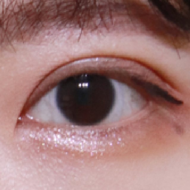 Front view of eyes 3 months after natural adhesion double eyelid surgery