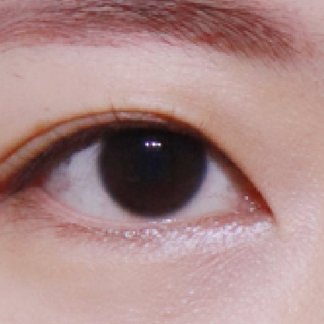 Front view of eyes before natural adhesion double eyelid surgery