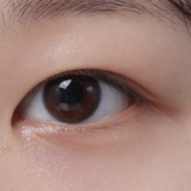 Front view of eyes 3 months after natural adhesion double eyelid surgery