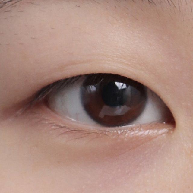 Front view of eyes before natural adhesion double eyelid surgery