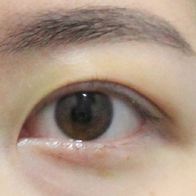 Front view of eyes 3 months after natural adhesion double eyelid surgery