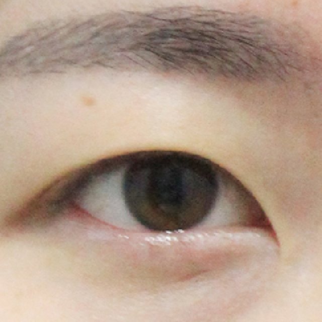 Front view of eyes before natural adhesion double eyelid surgery