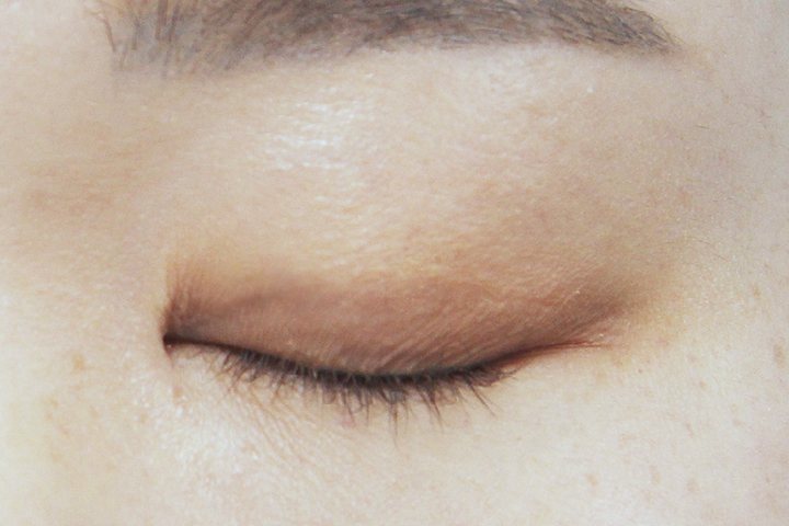 Closed eyelid 3 months after incisional double eyelid surgery